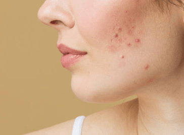 Acné fongique : Comment traiter ce type d'acné encore méconnu ...