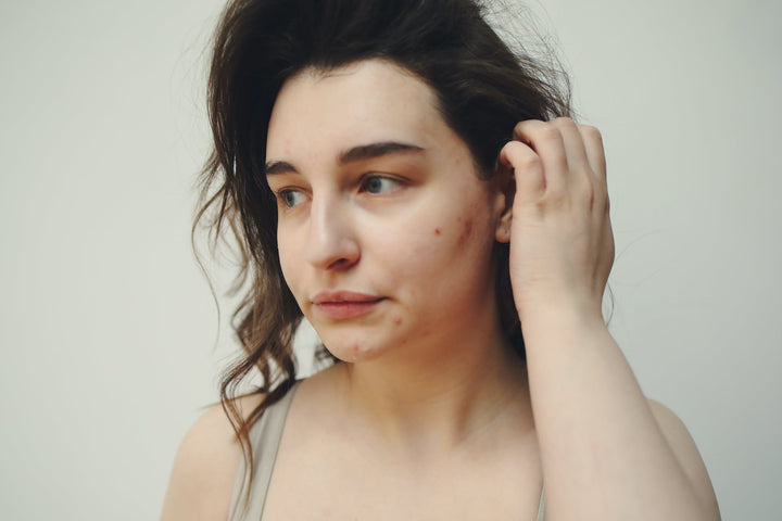 Boutons sur le visage ? Nos 5 conseils pour les éviter
