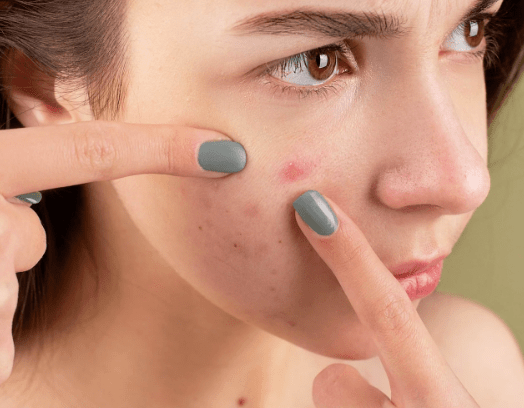 Cicatrices d'acné : les gestes à éviter et les produits naturels pour les estomper