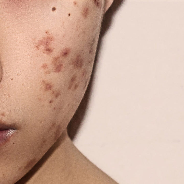 Comment les huiles essentielles peuvent aider à réduire les cicatrices d'acné