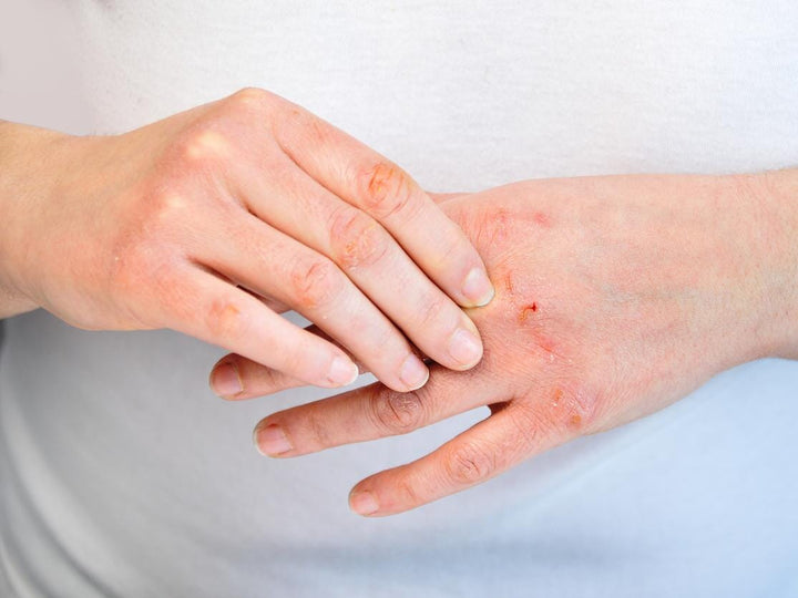 Comment traiter l'eczéma avec des vésicules de manière naturelle