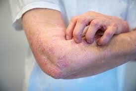 Comprendre le psoriasis : symptômes, causes et traitements