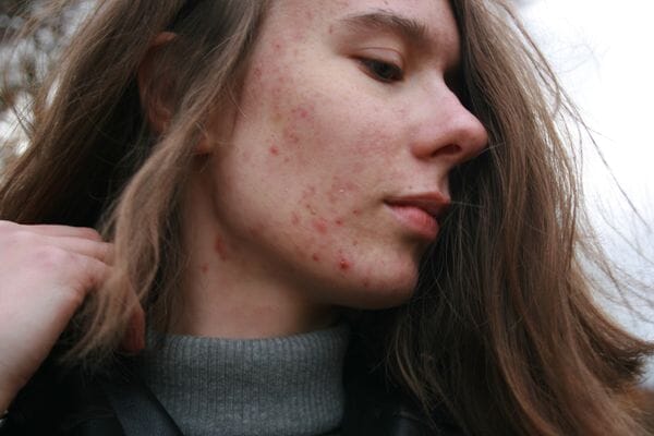 Comprendre les causes et solutions naturelles contre l'acné