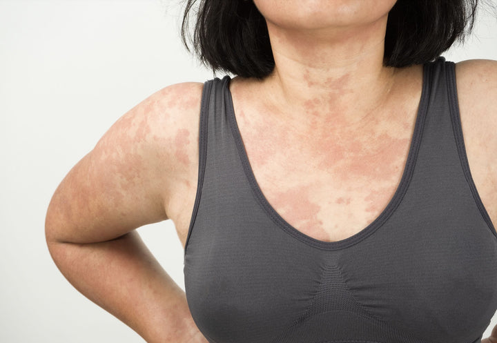 Éruption cutanée et allergie : causes, symptômes et traitement naturels de l'urticaire