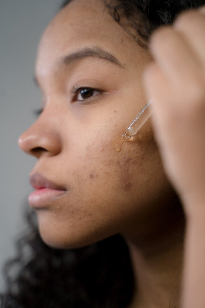 L'acné ça laisse des taches : Nos conseils pour en venir à bout