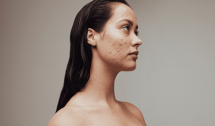 Les imperfections cutanées : ce que vous devez savoir