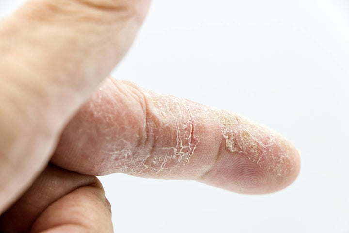 Maladies inflammatoires de la peau : comment les soulager ?