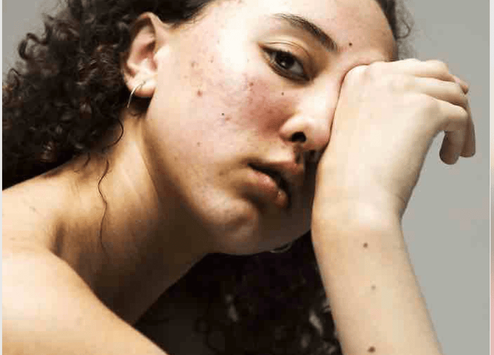 Peau abîmée et irritée : Découvre comment apaiser et réparer ta peau