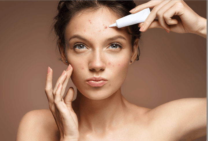 Soulager l'acné hormonale : nos meilleurs soins naturels pour une solution durable