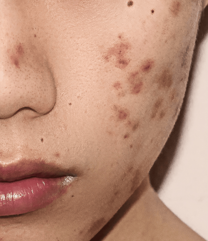 Tout ce que vous devez savoir sur l'inflammation cutanée : symptômes, causes et traitement naturel