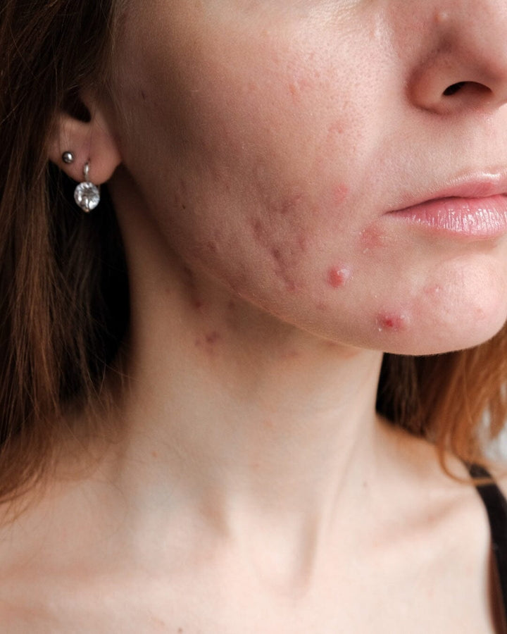 Traiter l'acné naturellement : Les huiles essentielles, vos alliées pour une peau saine