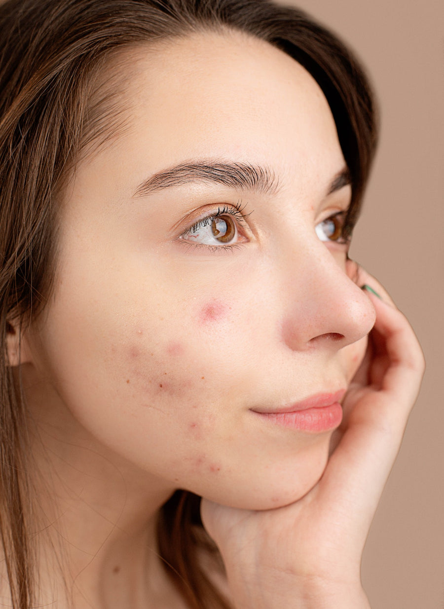 Roaccutane : le remède miracle contre l'acné ? – Slolie