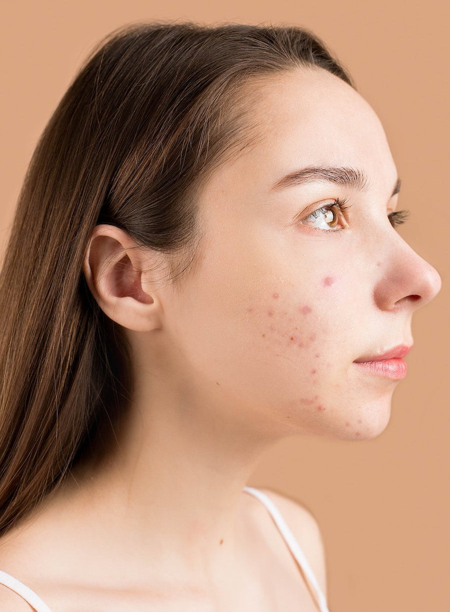 crème contre les cicatrices d'acné